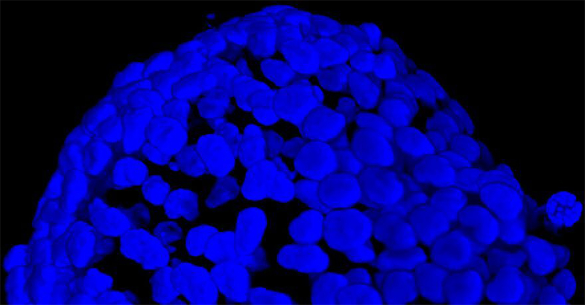 3D tumor spheroids 1